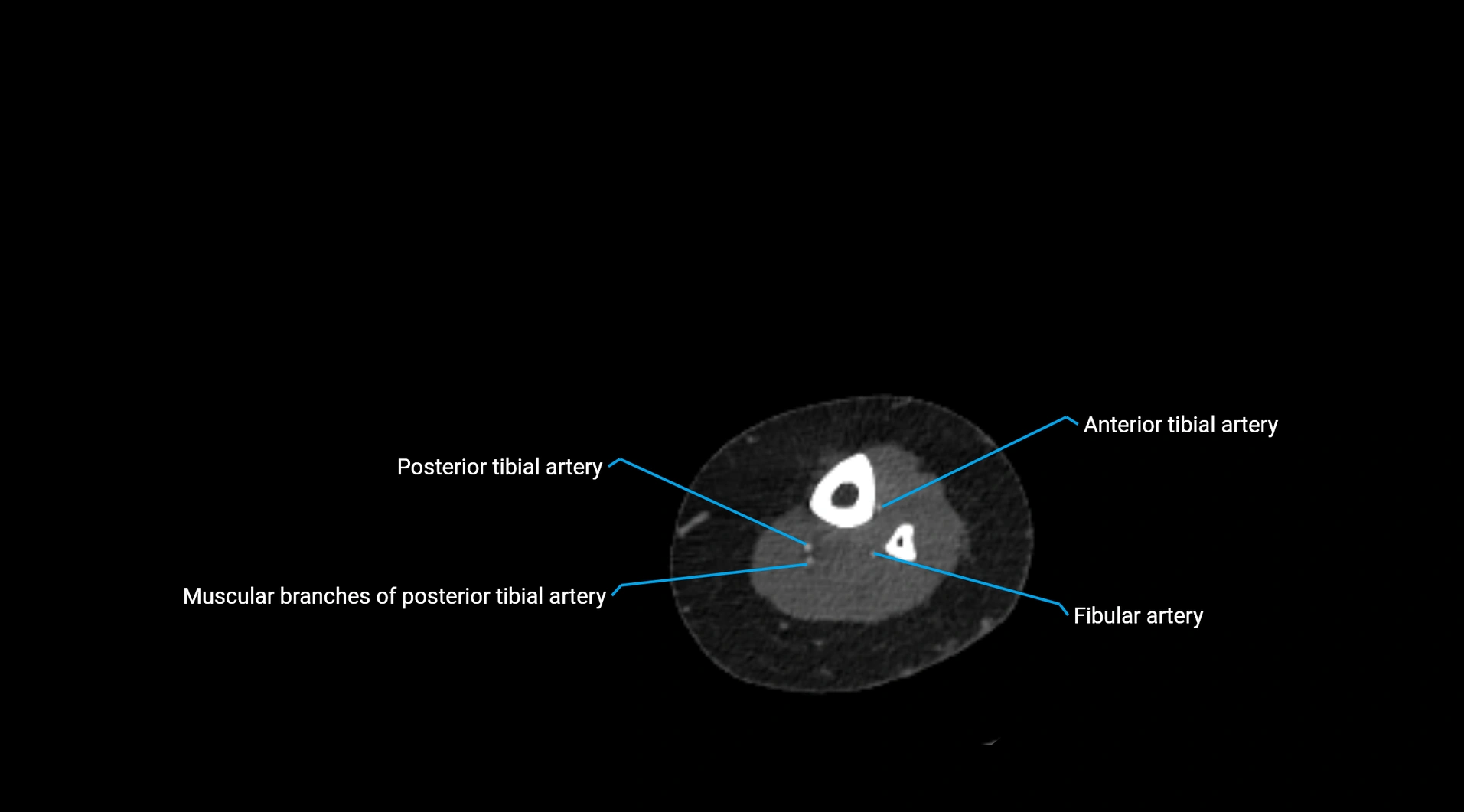 CTA lower limb cross sectional anatomy labelled image _234.webp